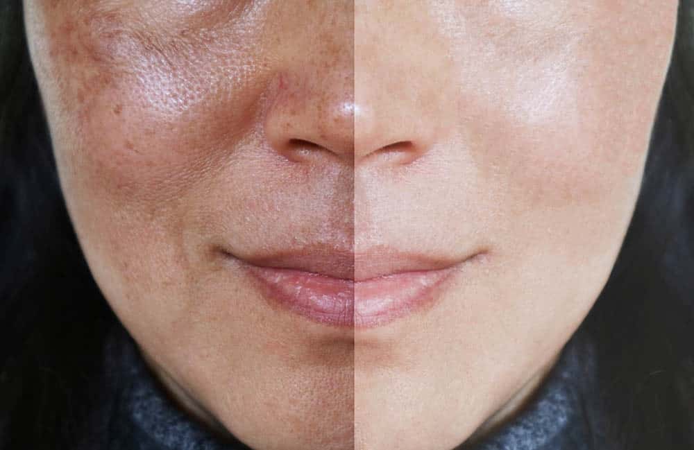 Pigmentation Treatment.jpeg